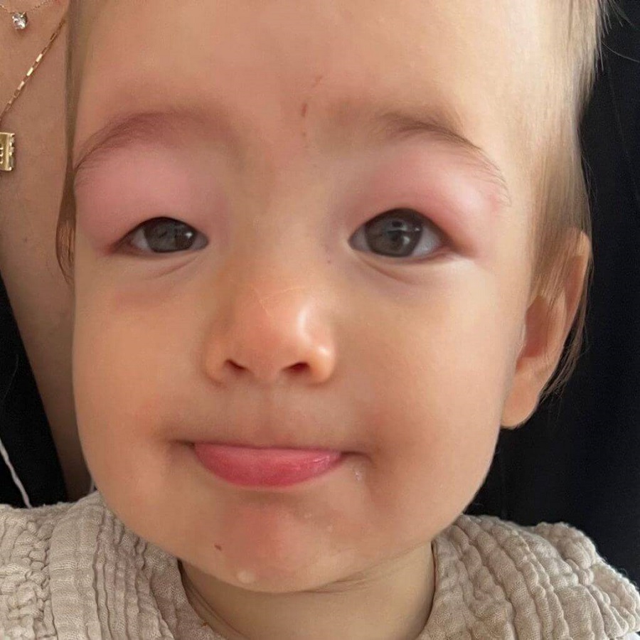 bug bites on toddler when to worry